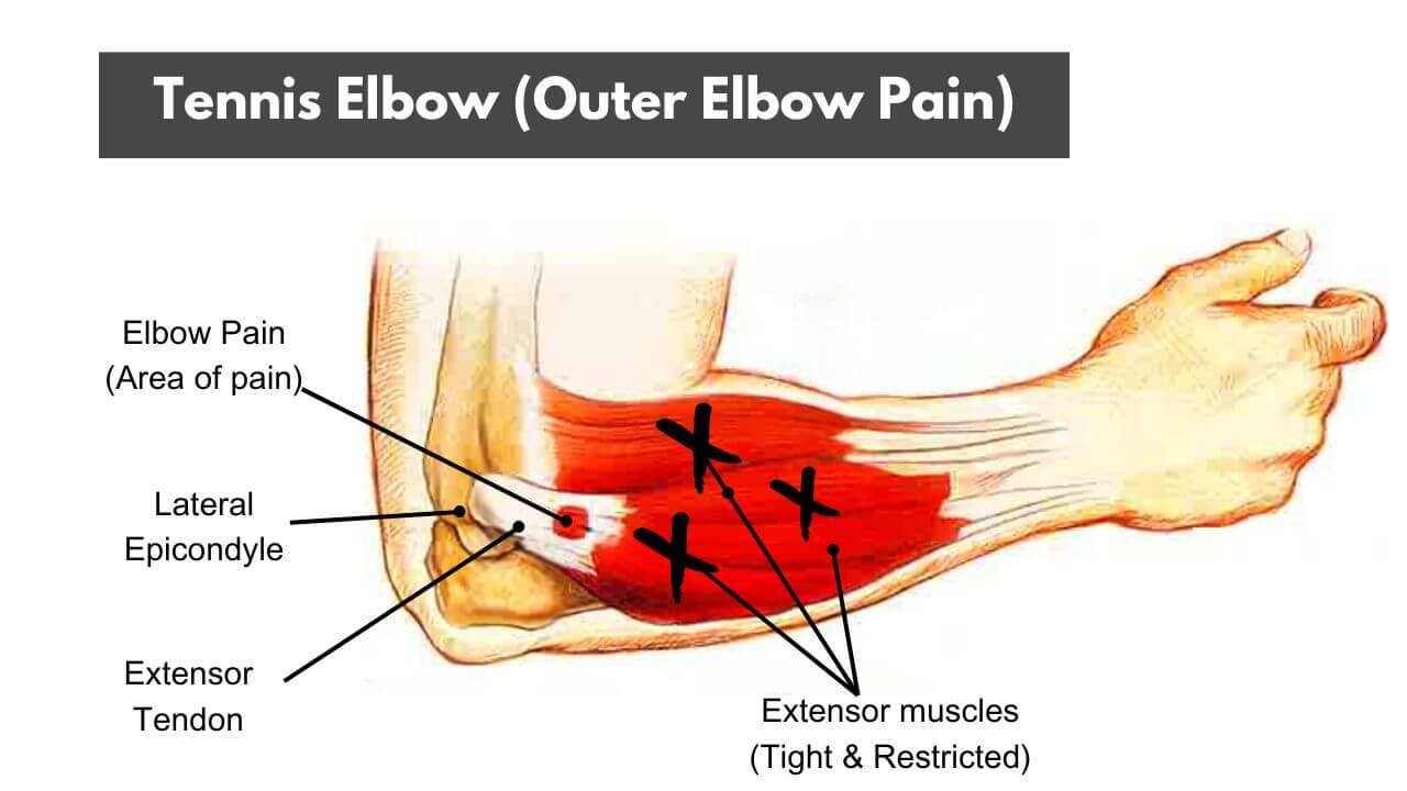 An illustration of tennis elbow, the wrist extensor muscles, and the common extensor tendon