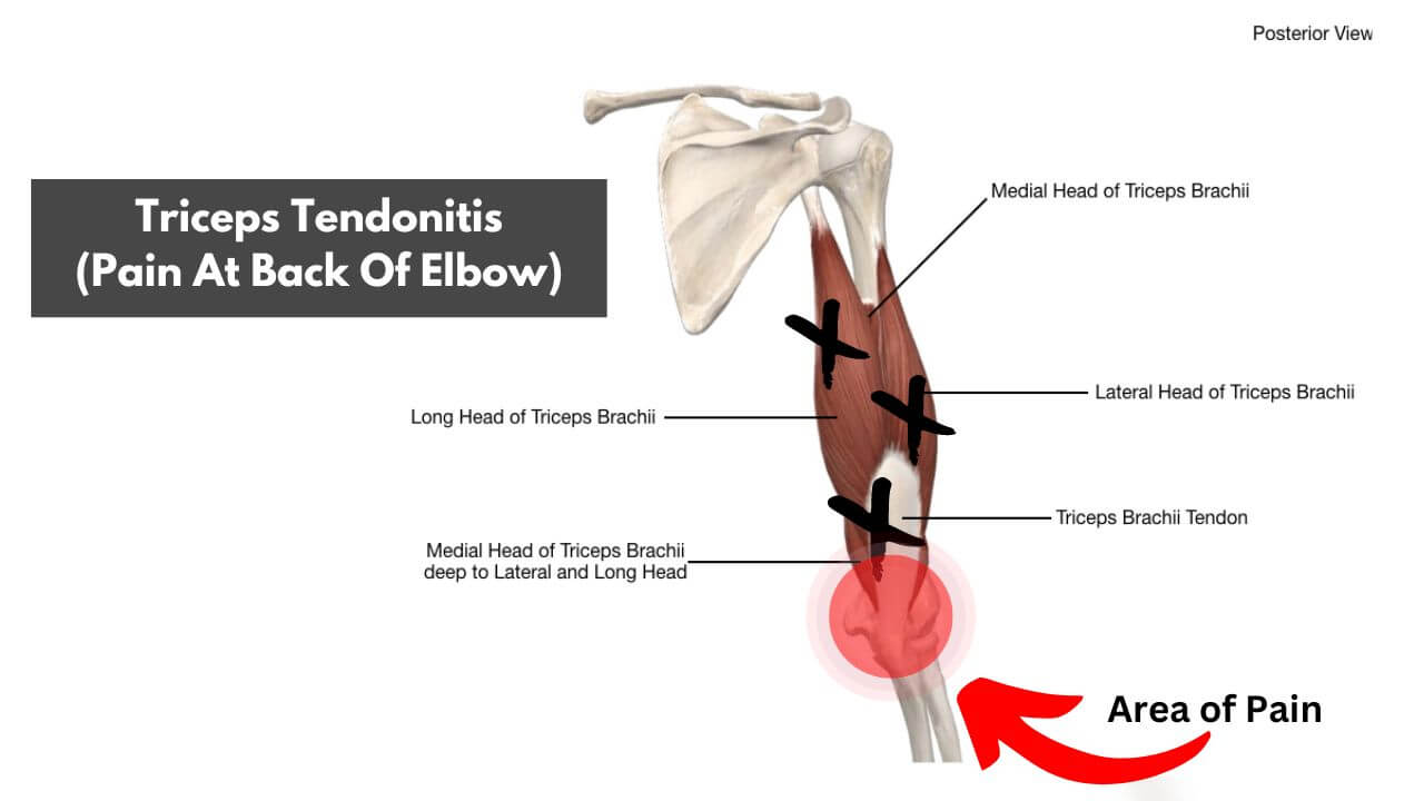 An illustration of tendonitis in the triceps brachii tendon