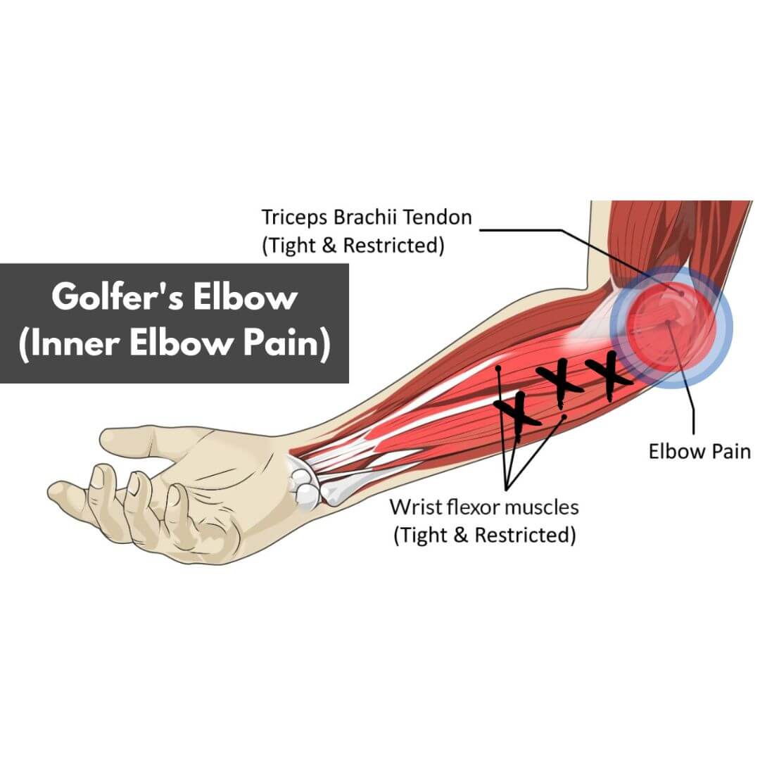What causes pain inside the elbow?