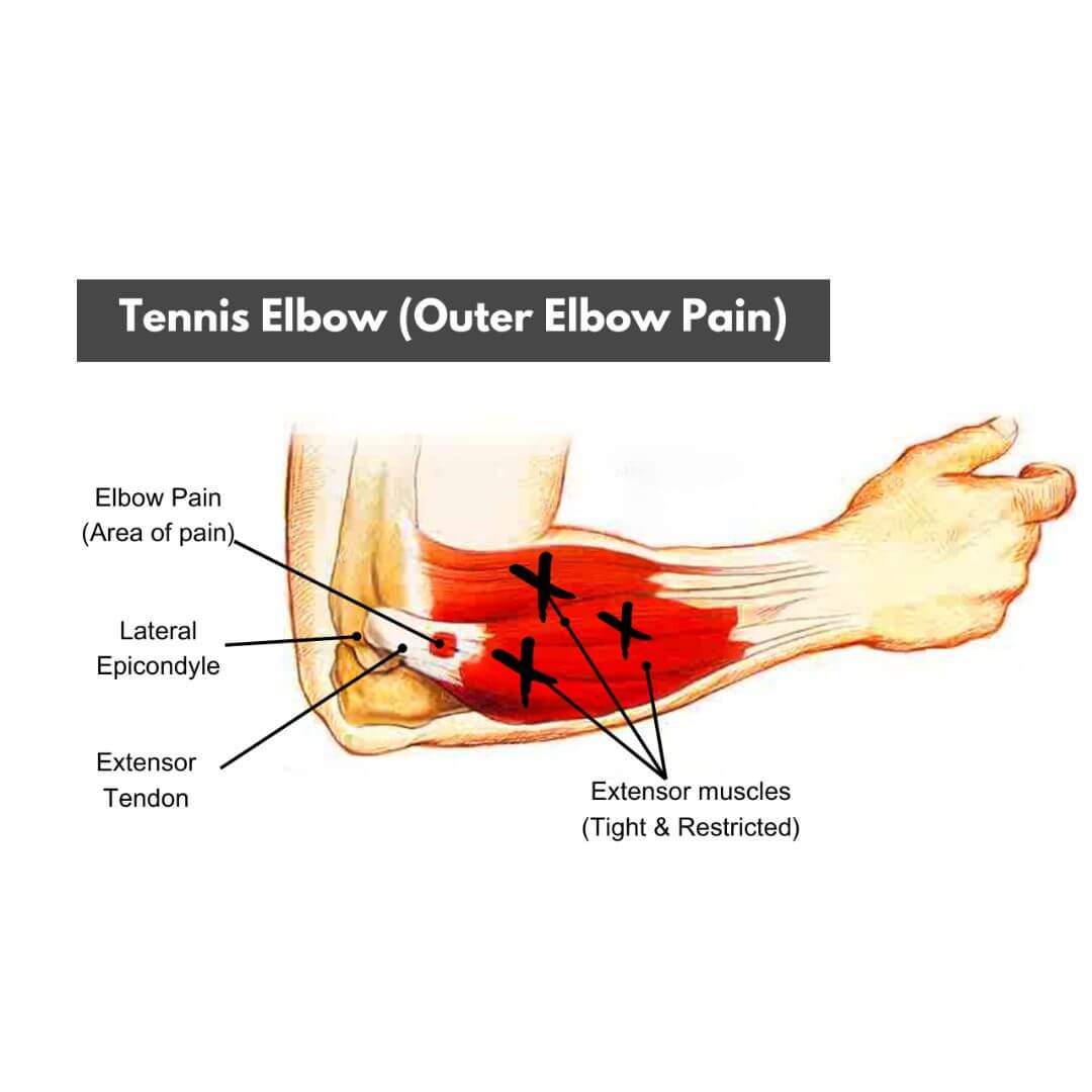 What causes pain outside the elbow?