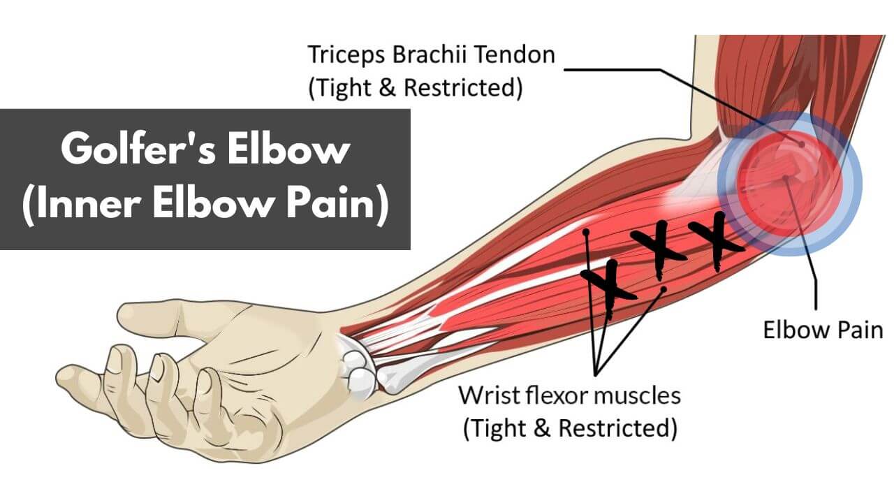 An illustration of golfer's elbow and the wrist flexor muscles