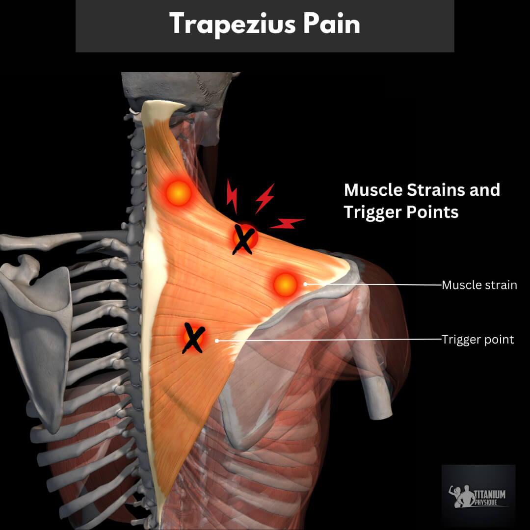 Trapezius And Neck Pain